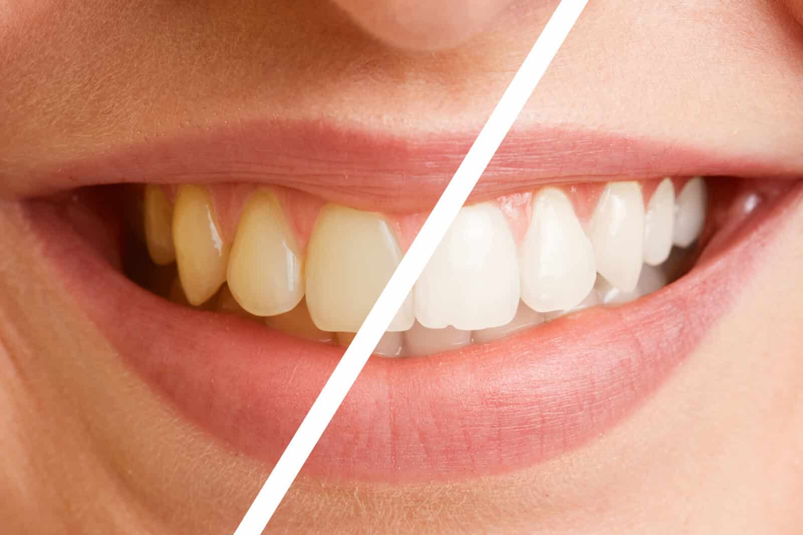Weiße Zähne durch Bleaching